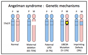 Angelman Syndrome Is A Genetic Disease With No Cure Scientists Found ...